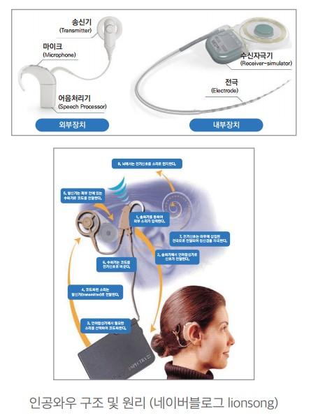 인공와우의 구조와 원리 / 블로그 갈무리
